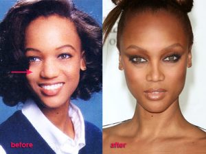 Celebrity-Tyra-Banks-Before-After-Plastic-Surgery
